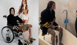 Colombian man spends $175,000 to stretch his legs to grow 6 inches