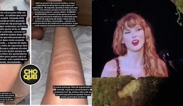 Fans suffered second-degree burns after attending Taylor Swift’s concert