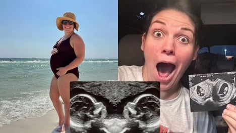 Woman born with two uteruses is now pregnant in both of them, with a child in each at the same time