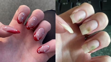 Teenager develops green mold fungus on nails after extended use of acrylic manicures
