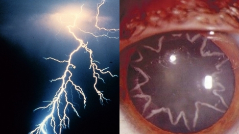 An electrician developed star-shaped cataracts in his eyes after being zapped by 14,000 volts of electricity