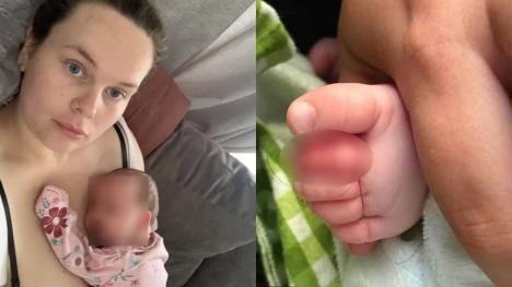Baby's toe narrowly escapes amputation; doctors explained  the problem is single strand of hair