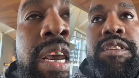 Mysterious lump on Kanye West's upper lip makes fans curious about its origin