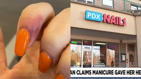 Young girl sues nail salon for $1.75M as she got herpes after getting her nails done there