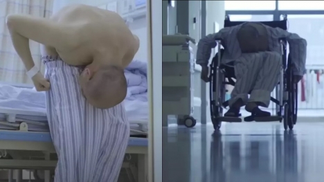 Man who was bent over for 28 years finally had surgery to stand up straight