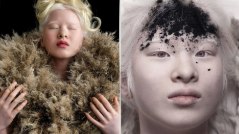 Xueli Abbing: Abandoned baby because of albinism becomes a Vogue model