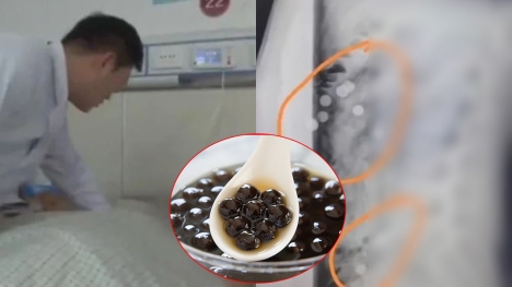 Man low back pain gets an X-ray, discovers his stomach is filled with pearl milk tea