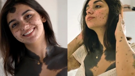 Young woman nicknamed 'monkey' because of a large birthmark but she stopped surgeries and found love