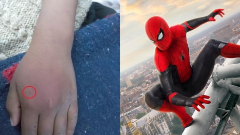 Boys let black widow spider bite them in hopes of gaining 'superpowers' and turning into Spider-Man