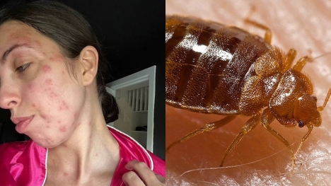 Holidaymaker covered in a HUNDRED bedbug bites after trip - the worst case doctor had EVER seen