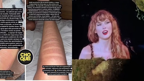 Fans suffered second-degree burns after attending Taylor Swift’s concert 