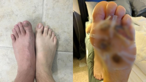 Texas man stunned after spotting an infection on foot from showering barefoot at the gym