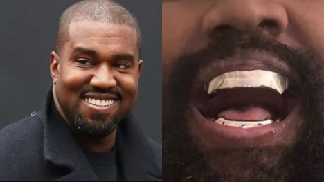 Kanye West paid $850,000 for 'permanent' titanium teeth