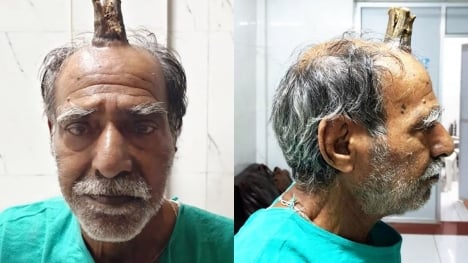 Doctor stunned after removing four-inch 'devil horn' from man's man