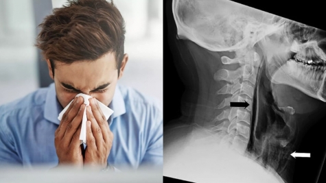 Rare medical case: Man tears hole in throat after trying to hold in sneeze