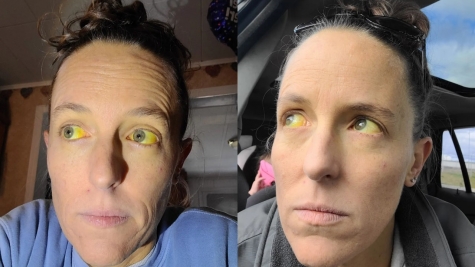 Woman suffers weird yellow eyes after taking herbal remedy for menopause