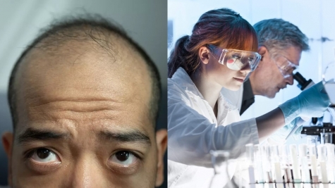 Experts state that humans could completely treat or even end the balding process