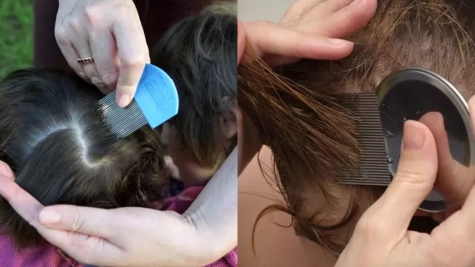 Vegan neighbor refuses to get rid of her child’s head lice because she's vegan