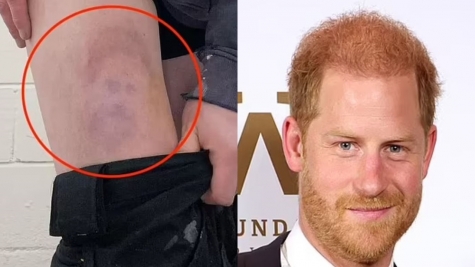   Footballer stunned by injury resembling prince Harry's face 