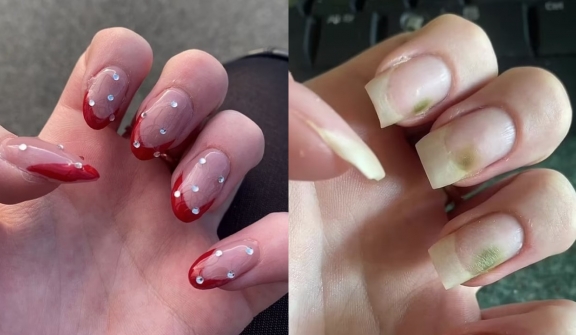 Teenager develops green mold fungus on nails after extended use of acrylic manicures