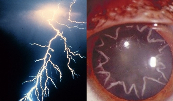 An electrician developed star-shaped cataracts in his eyes after being zapped by 14,000 volts of electricity