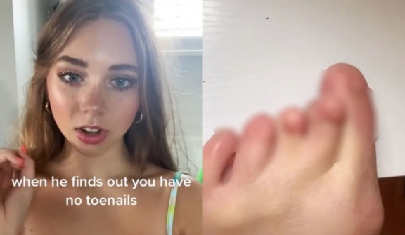 American woman was born without toenails, revealing the challenges she had to face