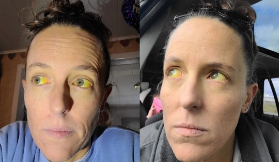 Woman suffers weird yellow eyes after taking herbal remedy for menopause