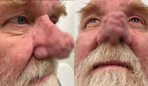 Man with 'Elephant Man' growth on his nose doesn't dare go out without his motorcycle helmet