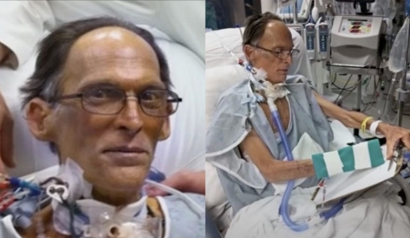 World's first man lives for a month without a heart or a pulse 