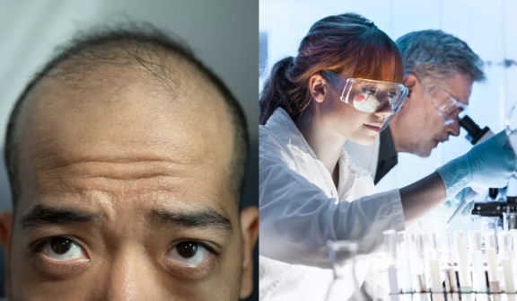 Experts state that humans could completely treat or even end the balding process