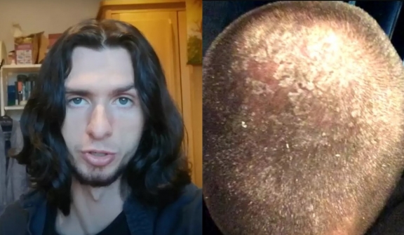 Man stuns people after revealing results of not using shampoo for seven years