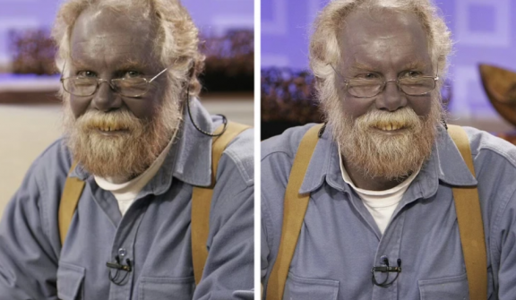 A man turned blue after long-term use of dietary supplements