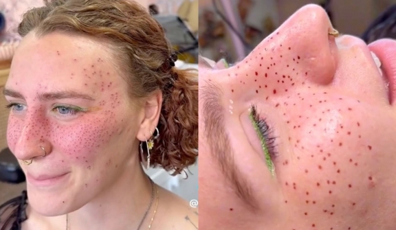 A woman gets fake freckles tattooed, with some predicting that they will 'age like a tramp stamp'