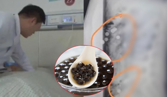 Man low back pain gets an X-ray, discovers his stomach is filled with pearl milk tea
