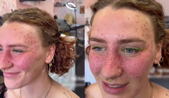 Internet divided over trend of tattooing 'permanent freckles' on the face