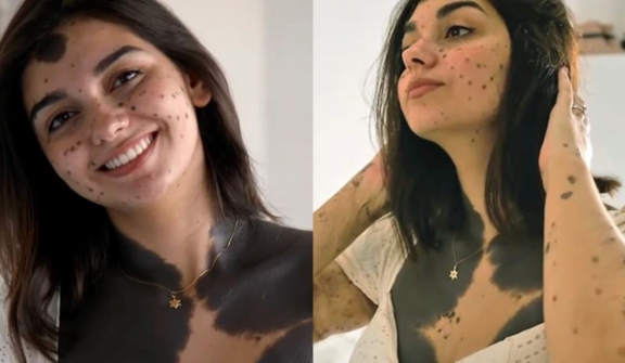 Young woman nicknamed 'monkey' because of a large birthmark but she stopped surgeries and found love