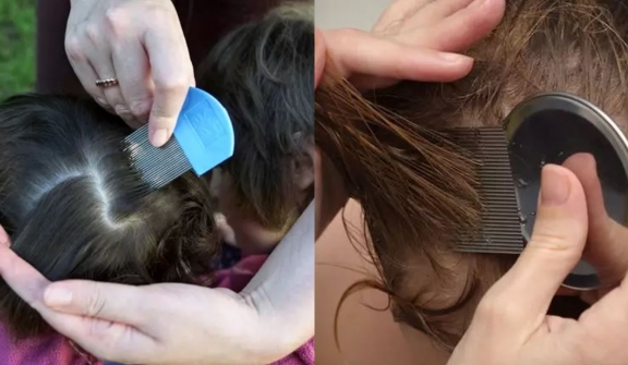 Vegan neighbor refuses to get rid of her child’s head lice because she's vegan
