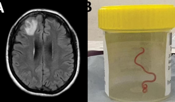 Doctors were left stunned by a live parasitic worm found in woman’s brain:  ‘It’s alive!’