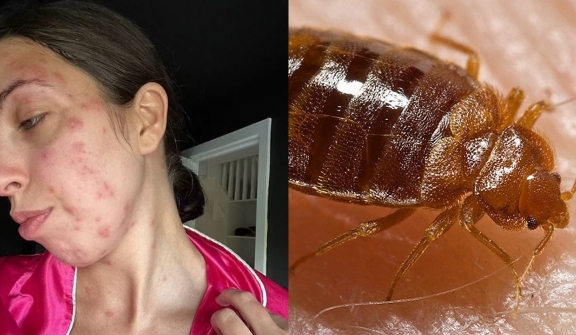 Holidaymaker covered in a HUNDRED bedbug bites after trip - the worst case doctor had EVER seen