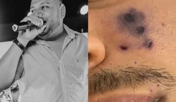 Singer passes away from spider bites on his face