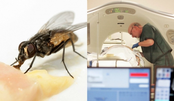 Doctors stunned after discovering fly buzzing in man's intestines  