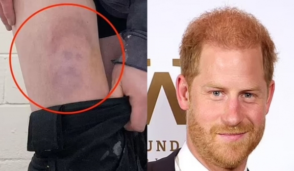   Footballer stunned by injury resembling prince Harry's face 