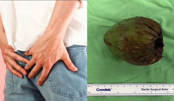 Doctor removed coconut from man's rectum