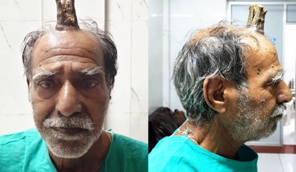 Doctor stunned after removing four-inch 'devil horn' from man's man