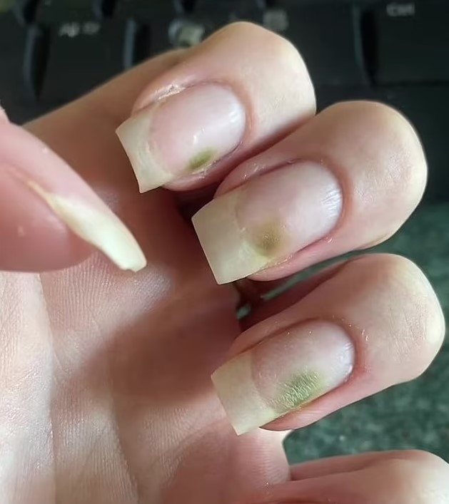 Teenager develops green mold fungus on nails after extended use of acrylic manicures 1