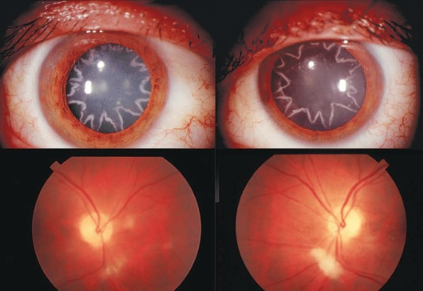 An electrician developed star-shaped cataracts in his eyes after being zapped by 14,000 volts of electricity 3