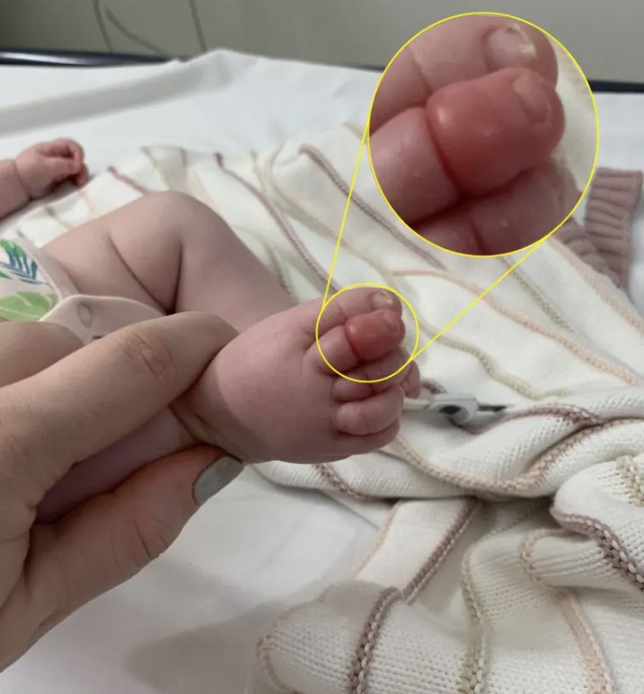 Baby's toe narrowly escapes amputation; doctors explained the problem is single strand of hair 4