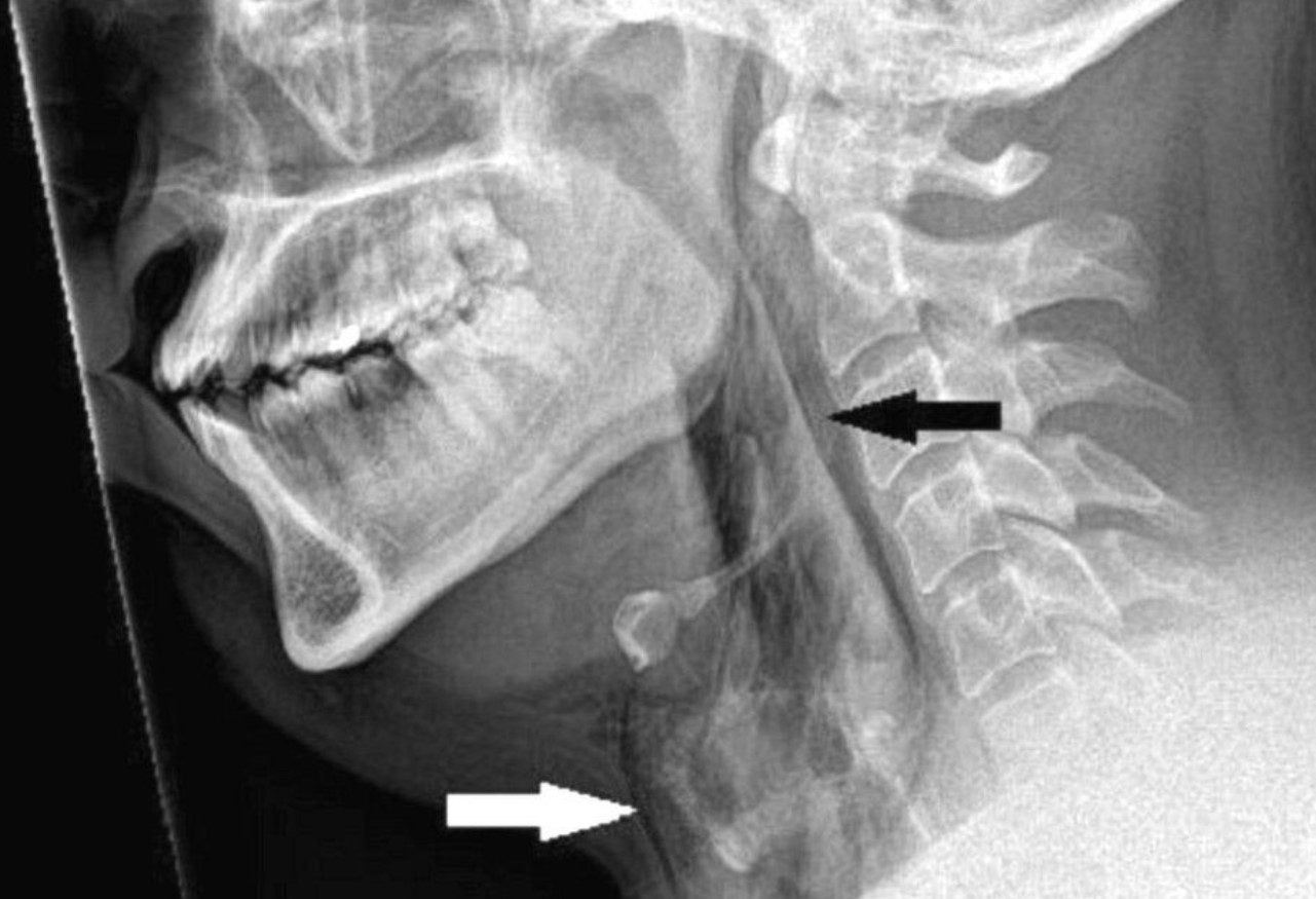 Rare medical case: Man tears hole in throat after trying to hold in sneeze 2