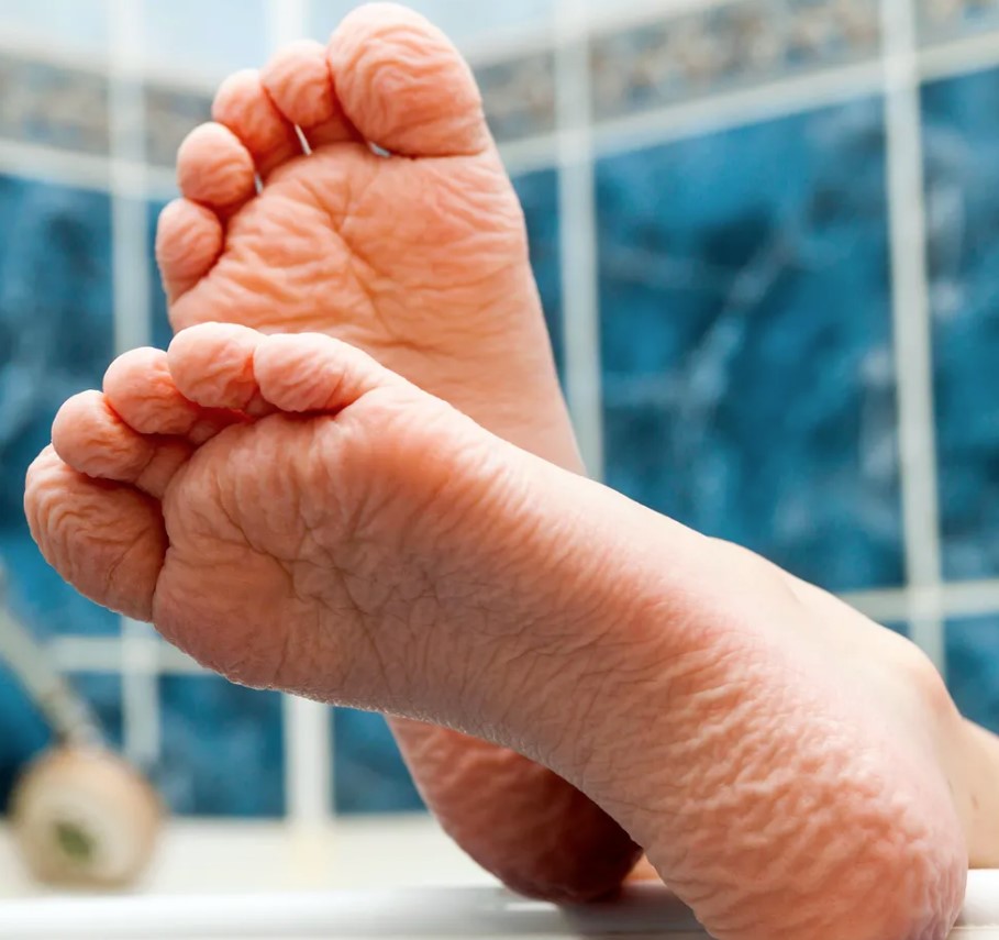 When fingertips or toes are damaged, reattached, or have severed sympathetic nerves, they may not wrinkle when immersed in water for a long time due to impaired nerve function. Image Credit: Getty