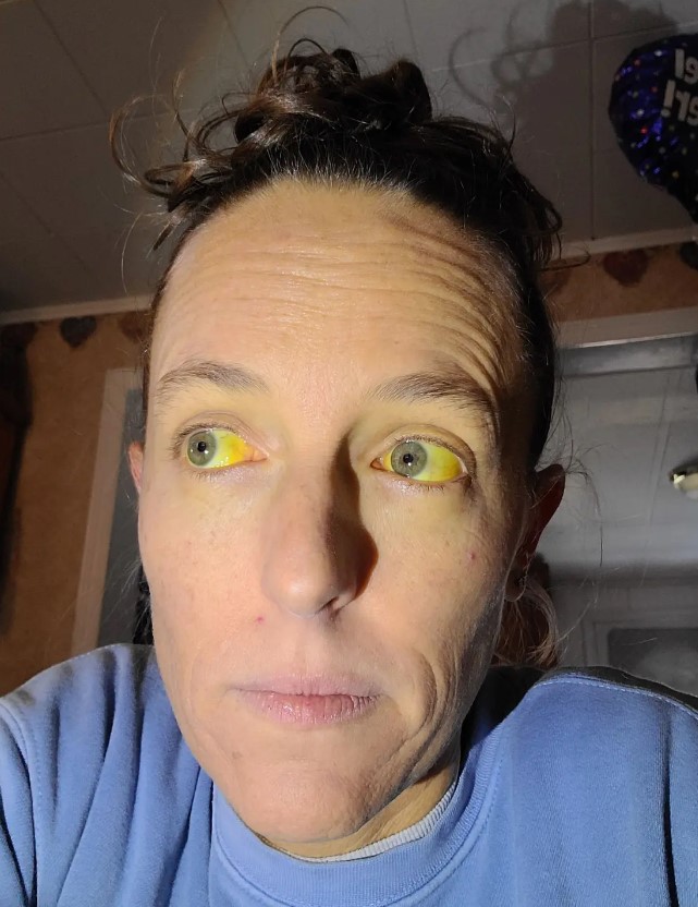 Woman suffers weird yellow eyes after taking herbal remedy for menopause 1